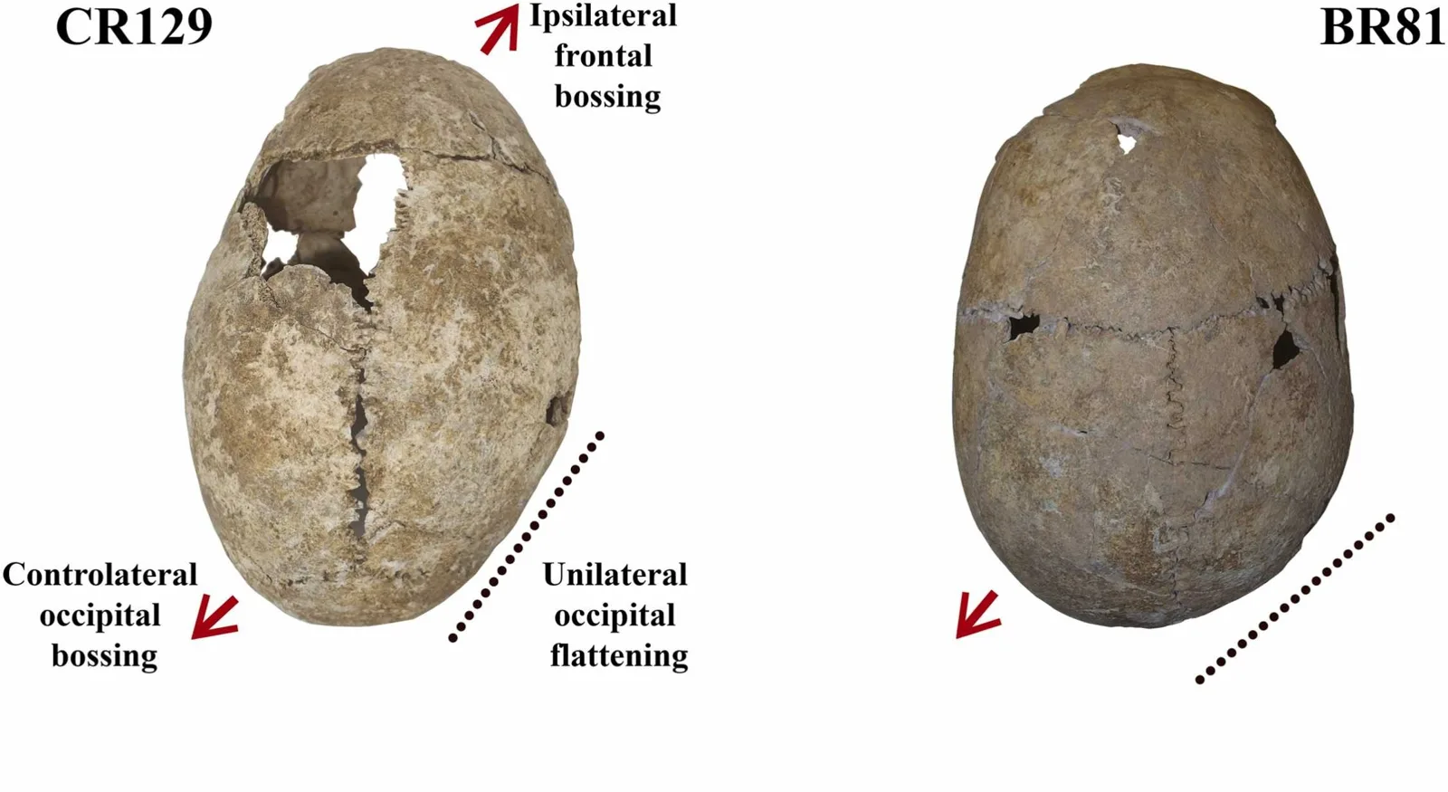 Two Iron Age skulls with flat head syndrome
