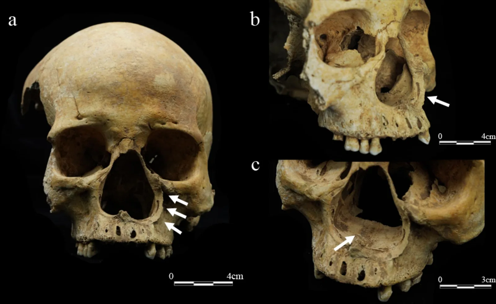 Three views of a skull with a widened, damaged nose opening, with white arrows pointing to small bony growths along its edge.
