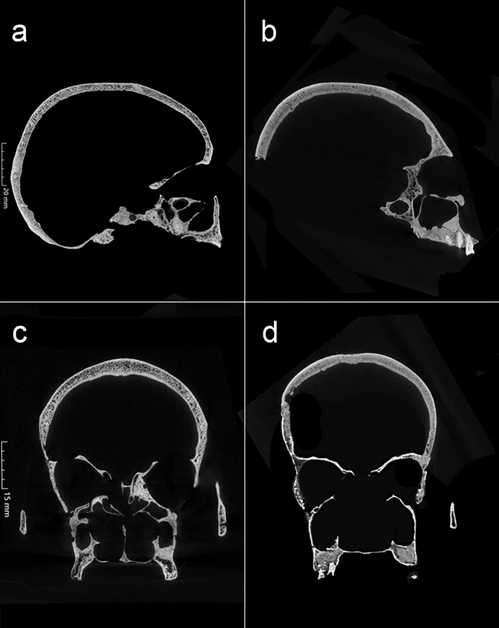 CT scans comparing M318's skull with that of M75